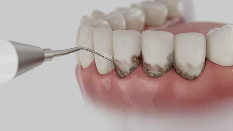 Trusted Wisdom Tooth Removal service in Del Monte Forest, CA - Dentist Open Now